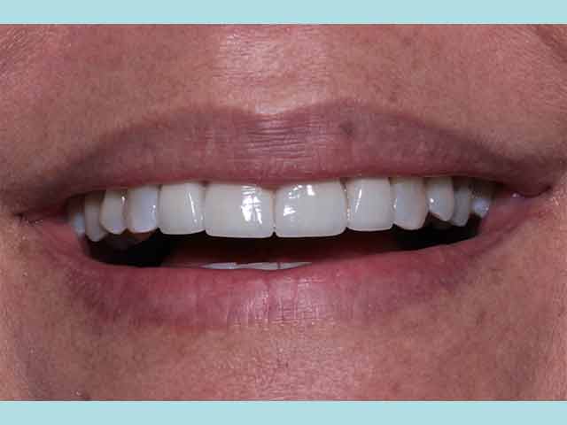 Transformative veneers await at our Costa Rican cosmetic dentistry practice.