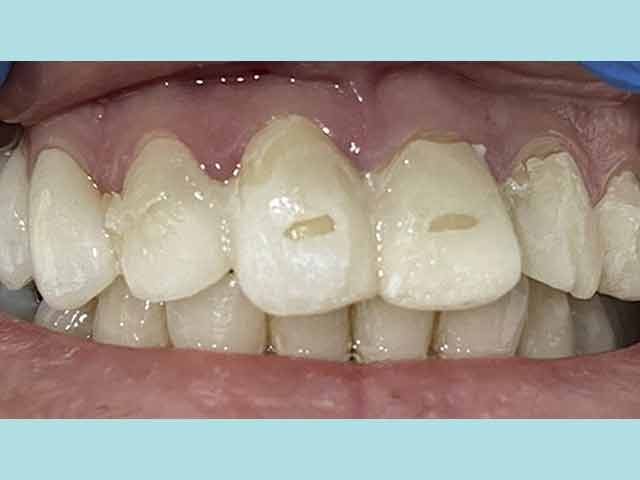 Revamp your smile with stunning veneers in Costa Rica.