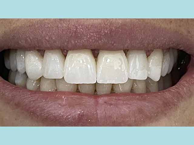 Experience the allure of veneers at our cosmetic dentistry clinic in Costa Rica.