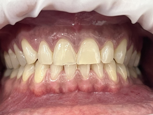 veneers before and after results