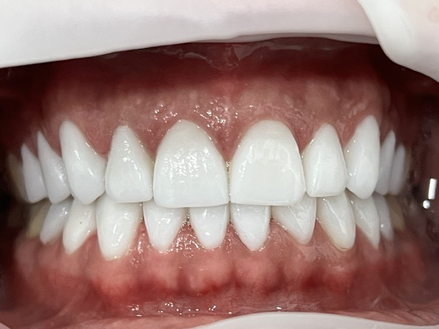 veneers before and after results