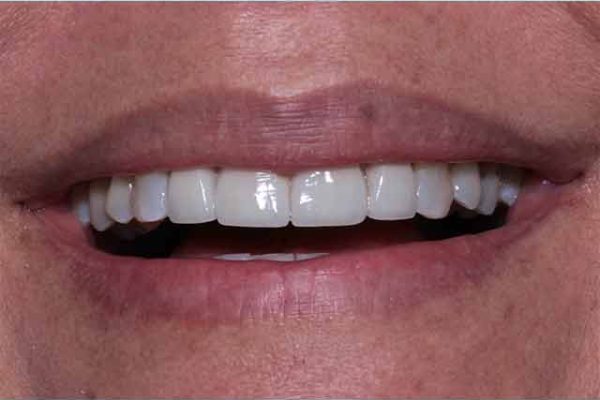 Experience-the-allure-of-veneers-at-our-cosmetic-dentistry-clinic-in-Costa-Rica-2