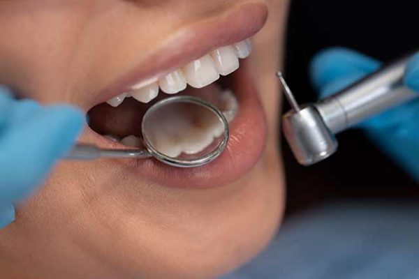 Our skilled dentists use advanced techniques and high-quality materials to create durable and aesthetically pleasing fillings that blend seamlessly with your natural teeth.