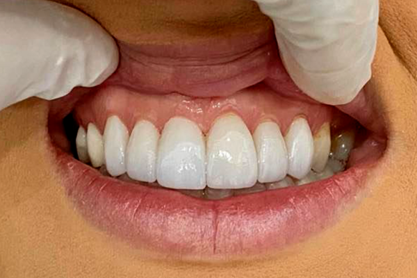 Mejor blanqueamiento dental en Costa Rica