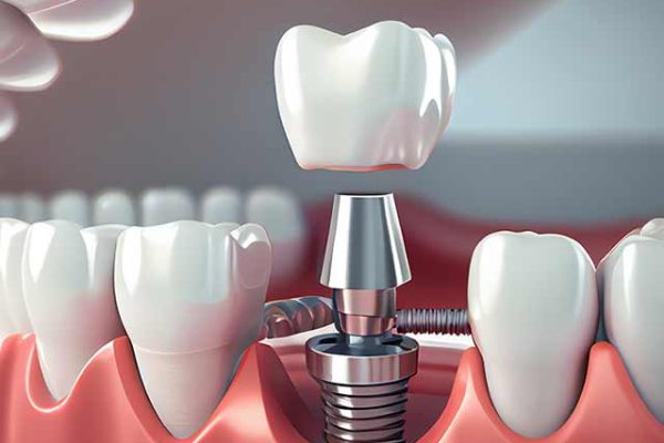 Our skilled team at Li Dental Costa Rica specializes in restoring smiles with precision-crafted dental implants, providing unmatched stability, comfort, and aesthetics.