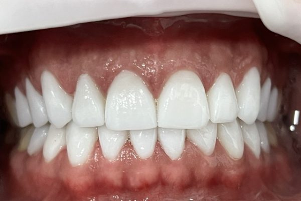 veneers before and after results